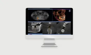 鎌倉市大船周辺でインプラントの実績の多さではおさらぎ歯科